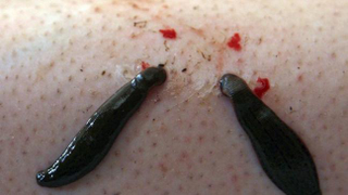 Illustration for article titled Best Leech Therapy Treatment In India